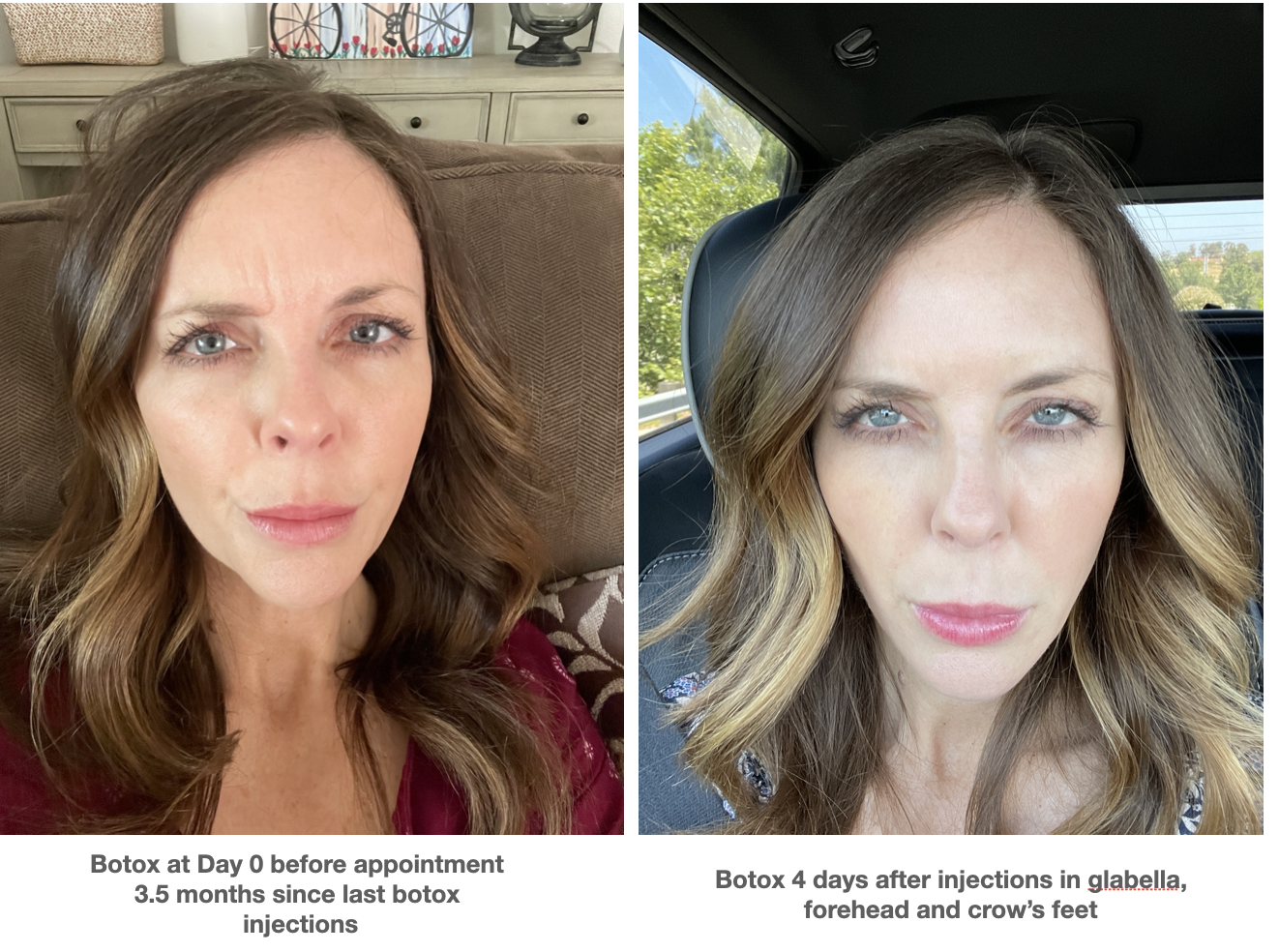 Botox results after 5 days